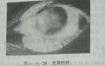 初級驗光師培訓知識點：影響視覺的原因分析