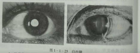 初級驗光師培訓知識點：影響視覺的原因分析