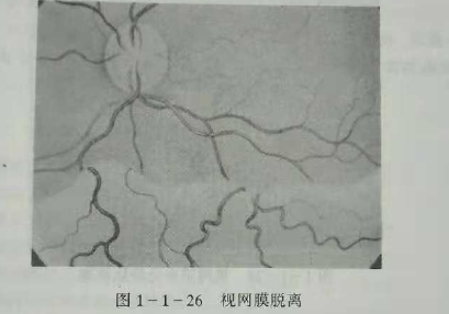 初級驗光師培訓知識點：影響視覺的原因分析