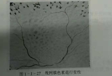 初級驗光師培訓知識點：影響視覺的原因分析