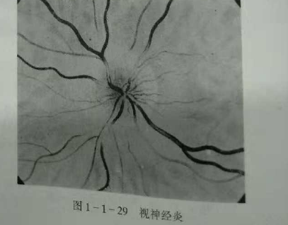 初級驗光師培訓知識點：影響視覺的原因分析