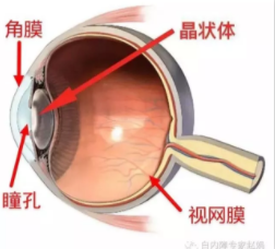 眼科專家趙娟：家長如何自查孩子有沒有先天性白內障