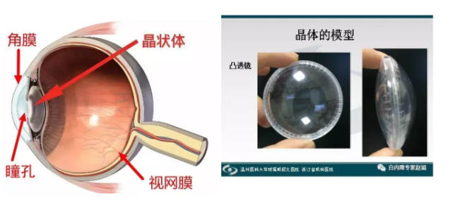 眼科專家趙娟：家長如何自查孩子有沒有先天性白內障