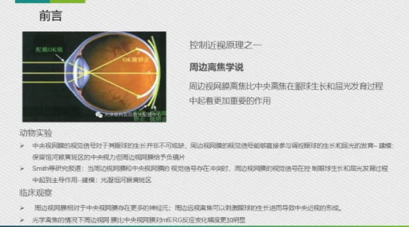 眼科醫院眼視光醫師分享角膜塑形鏡的復診流程