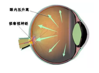 溫醫大梁遠波教授：大部分失明青光眼患者因就診不及時所致 | 世界青光眼日