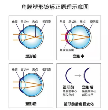 驗光師帶您了解角膜塑形鏡的來龍去脈