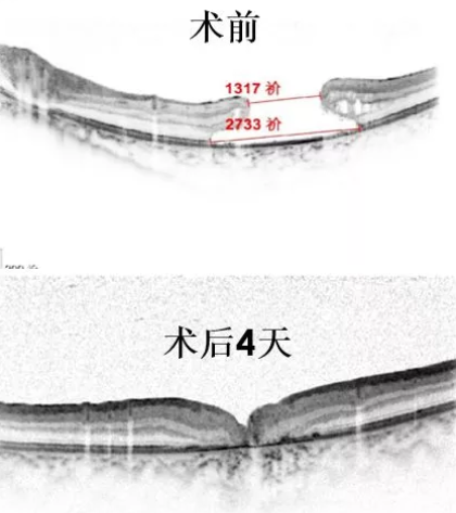 11歲患兒因激光筆損害視網膜造成罕見巨大黃斑裂孔，溫醫大眼視光成功治愈