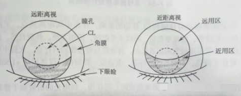 天津市眼科醫院視光中心張姝賢主任：多焦點軟性接觸鏡矯正老視的驗配要點