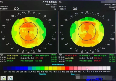 眼視光行業案例分享：適合高度近視的軟性隱形眼鏡